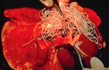 Kalp Kurdu Belirtileri ve Tedavisi